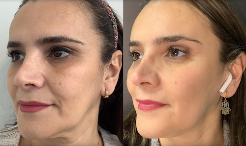 Thread Lift Face Lift Before After Mississauga Oakville